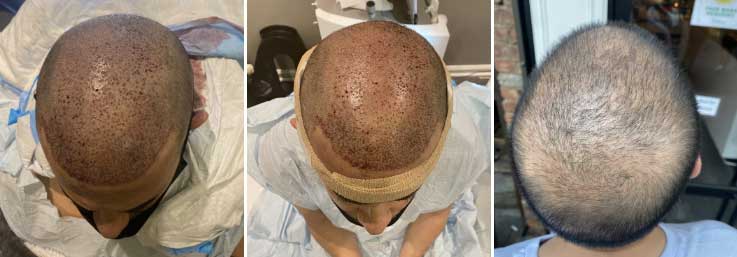 FUE hair transplant procedure